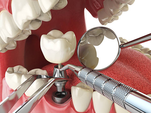 Best Emergency Dental Care for Broken or Chipped Teeth in Avila Beach, CA