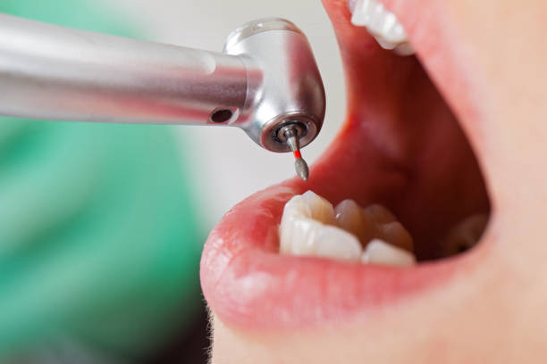 Best Emergency Root Canal Treatment in Avila Beach, CA